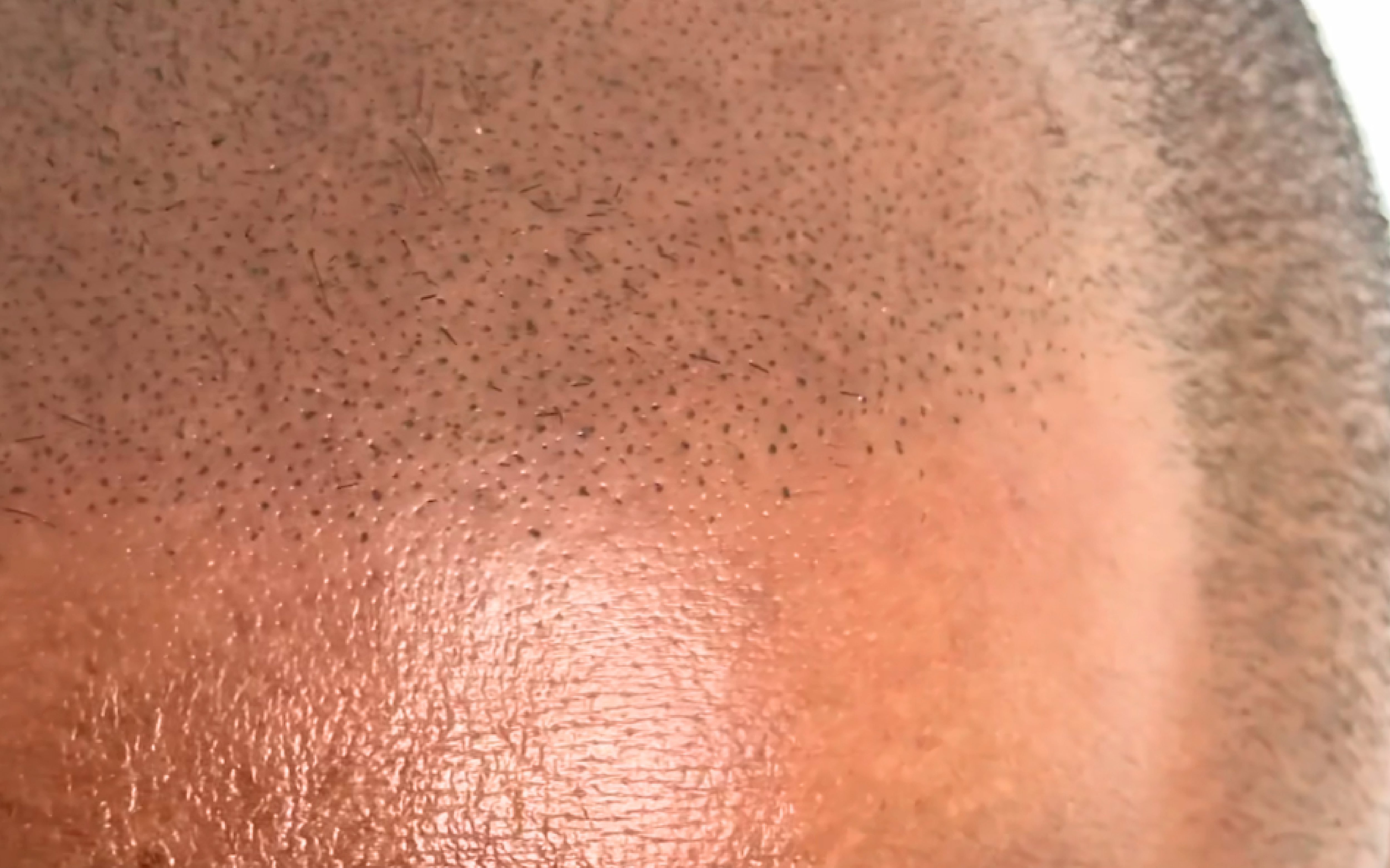 Tattoo Scalp (SMP)