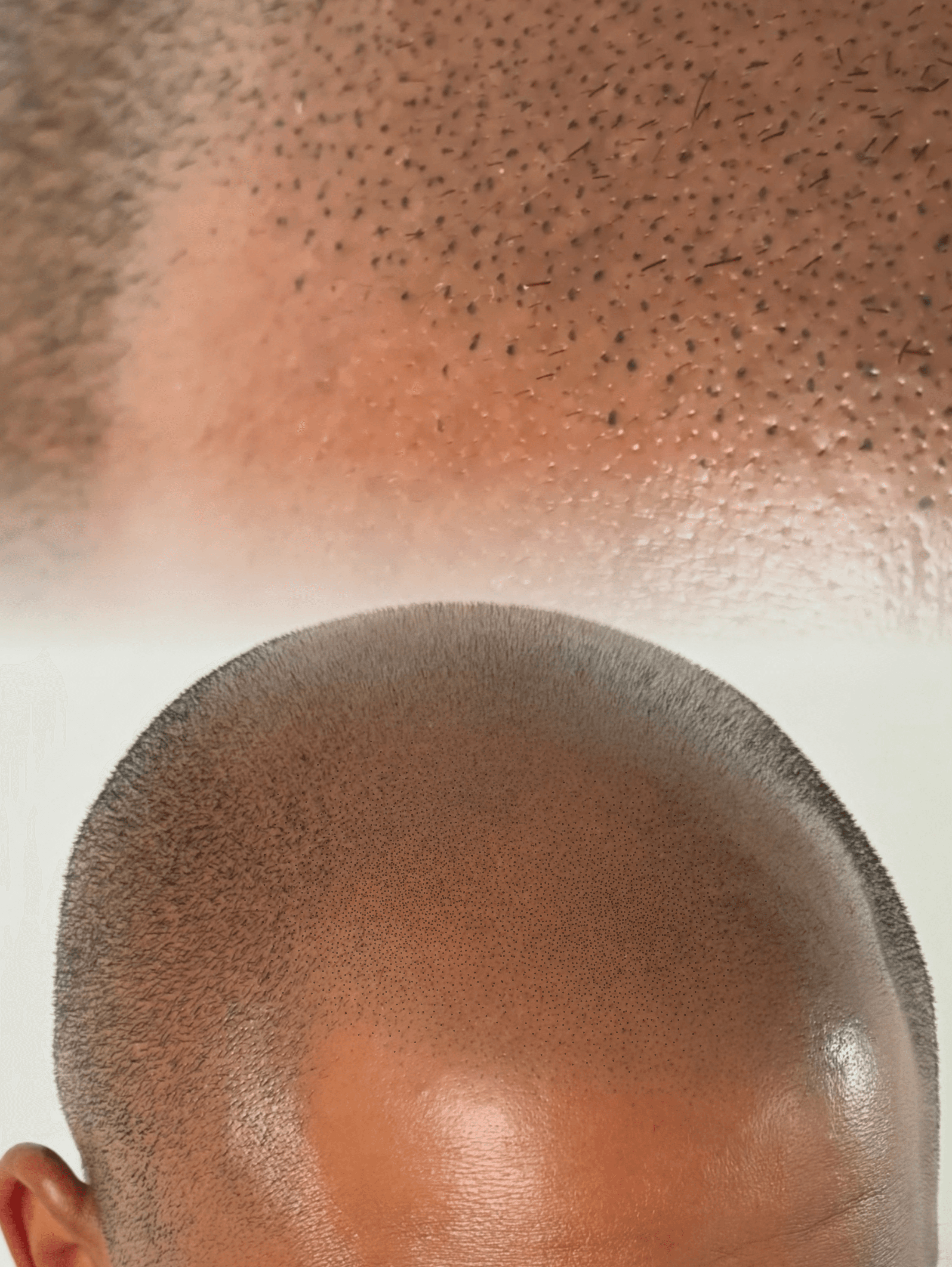 Tattoo Scalp (SMP)