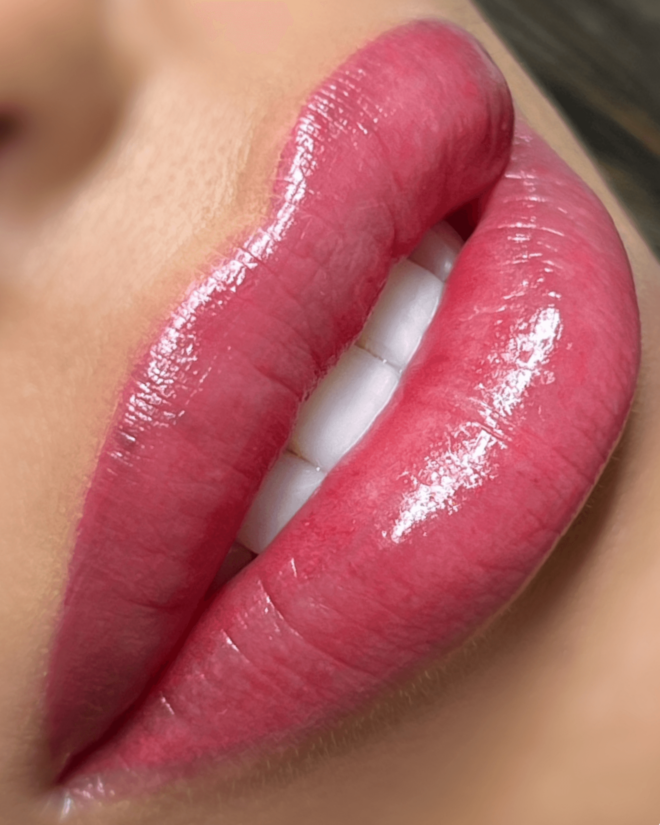 Nano Lips. After treatment