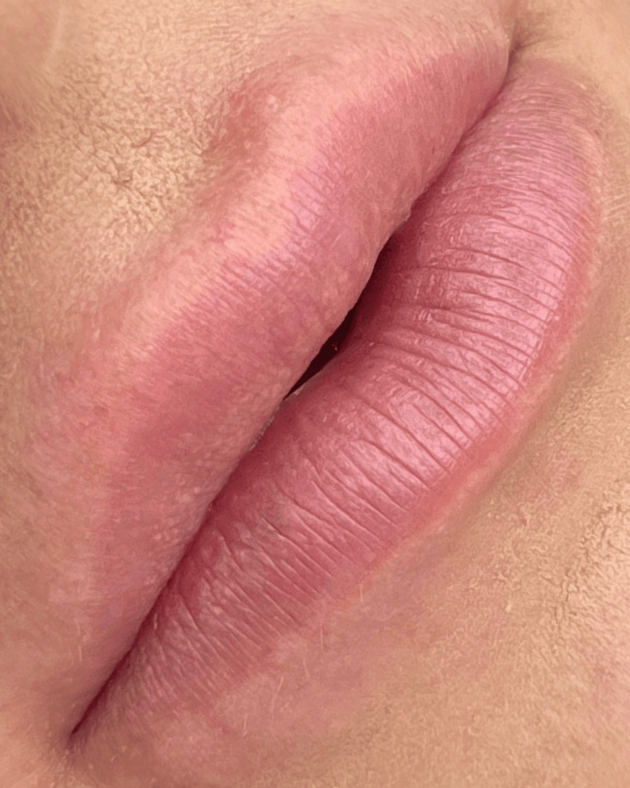 Nano Lips. Before treatment