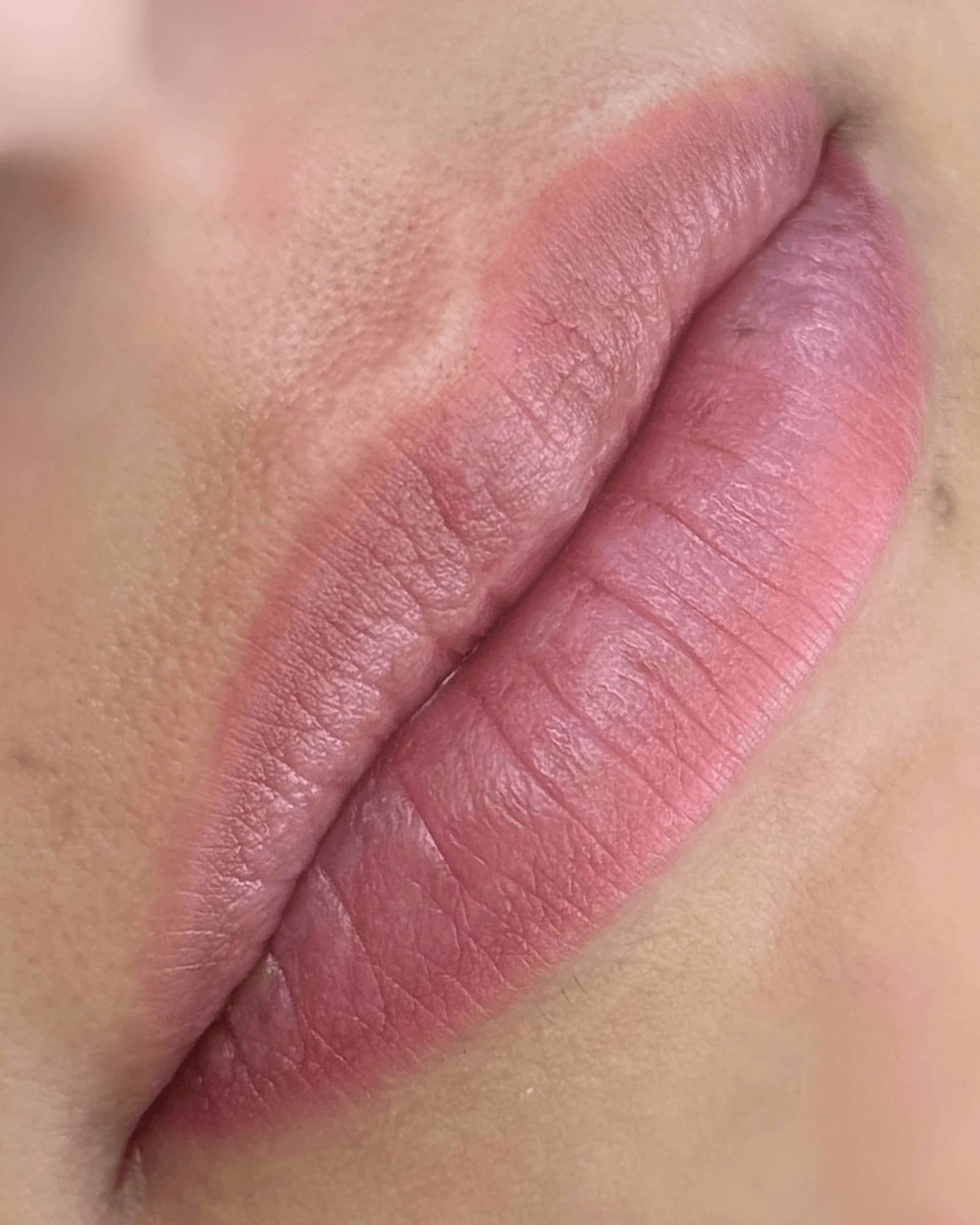 Nano Lips. Before treatment