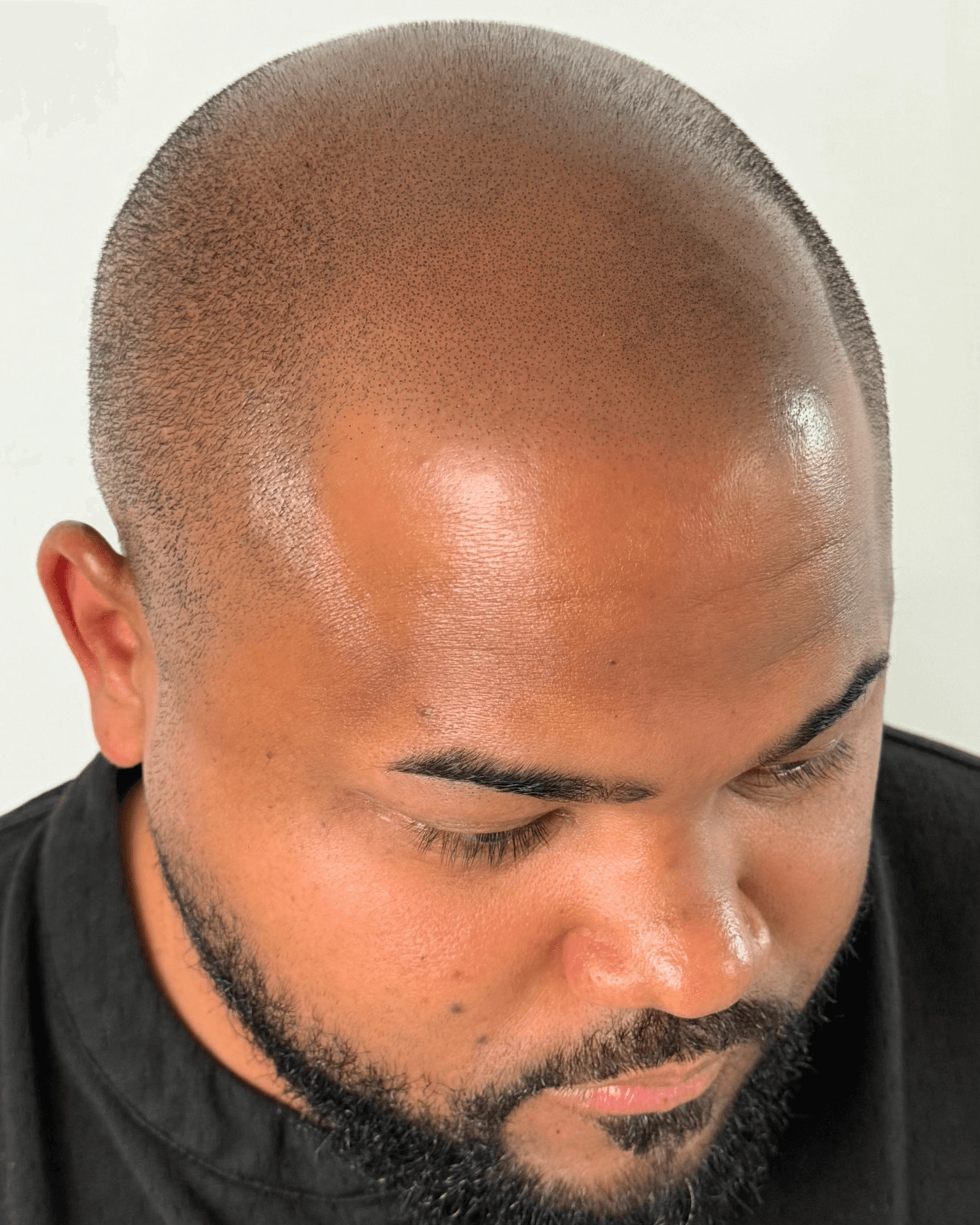 Scalp SMP. After treatment