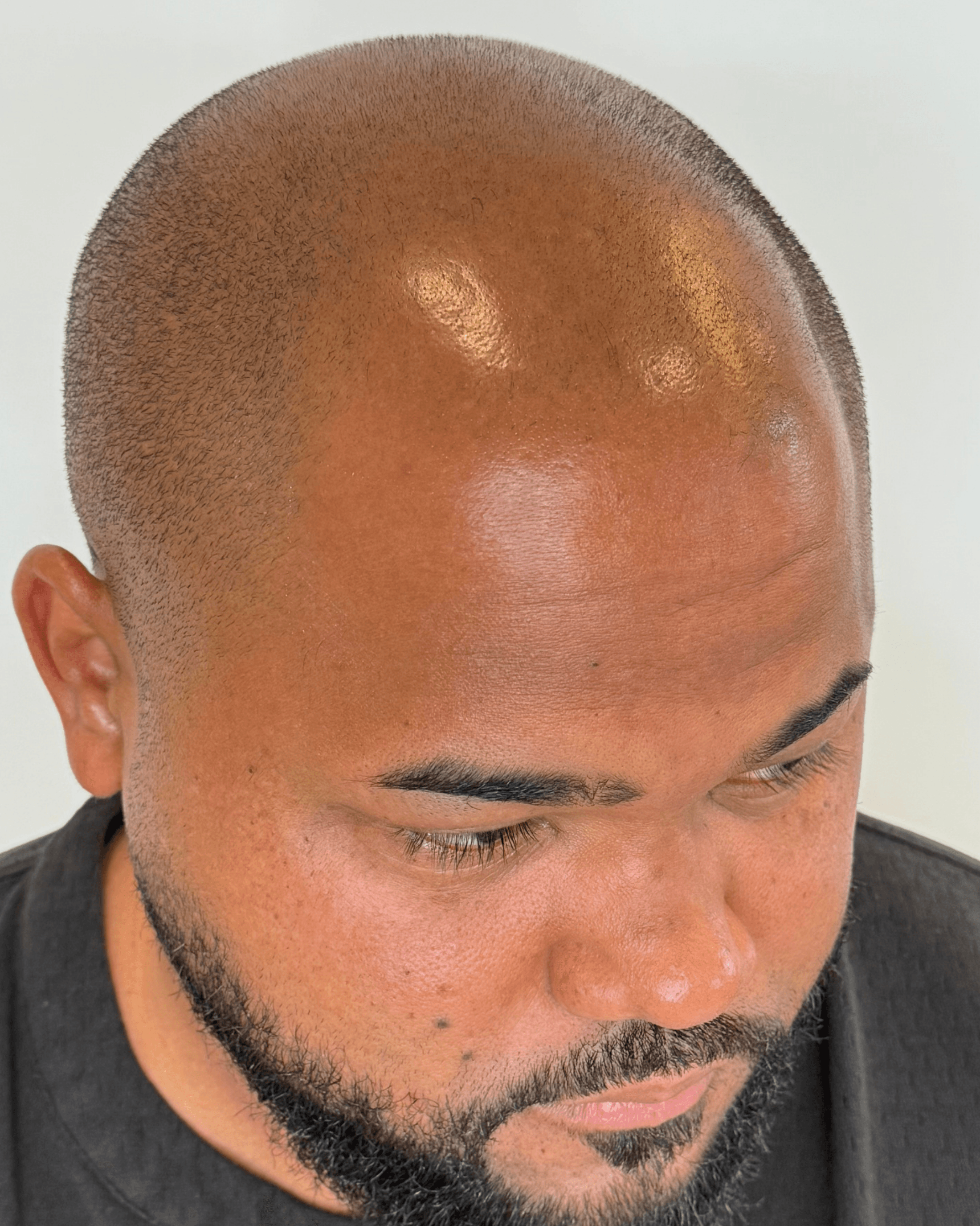 Scalp SMP. Before treatment