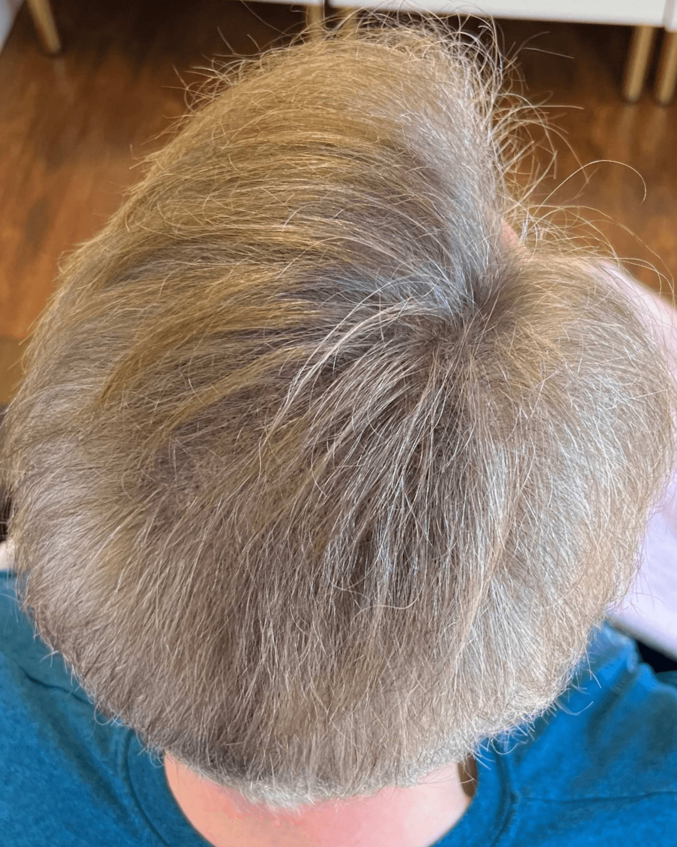 Tattoo Scalp (SMP). After treatment
