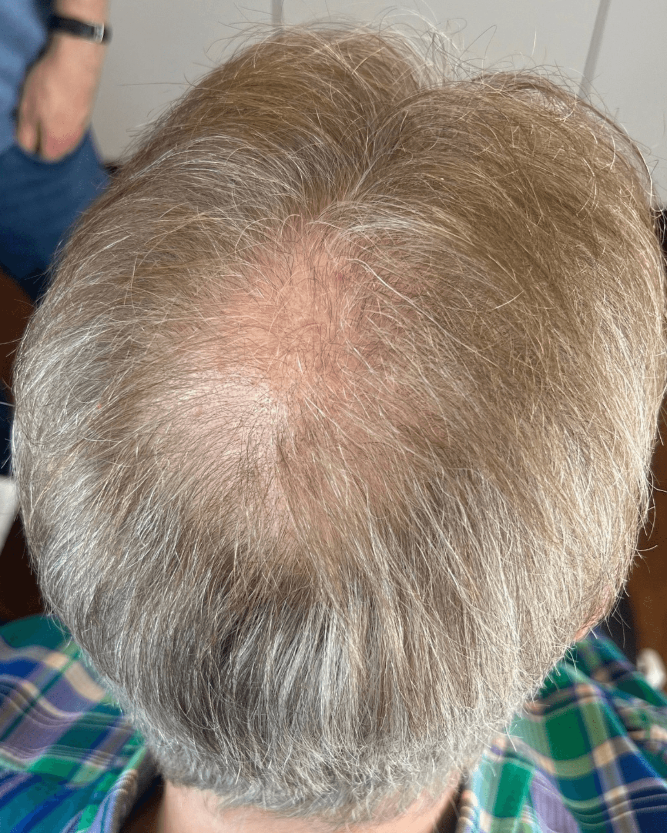 Tattoo Scalp (SMP). Before treatment