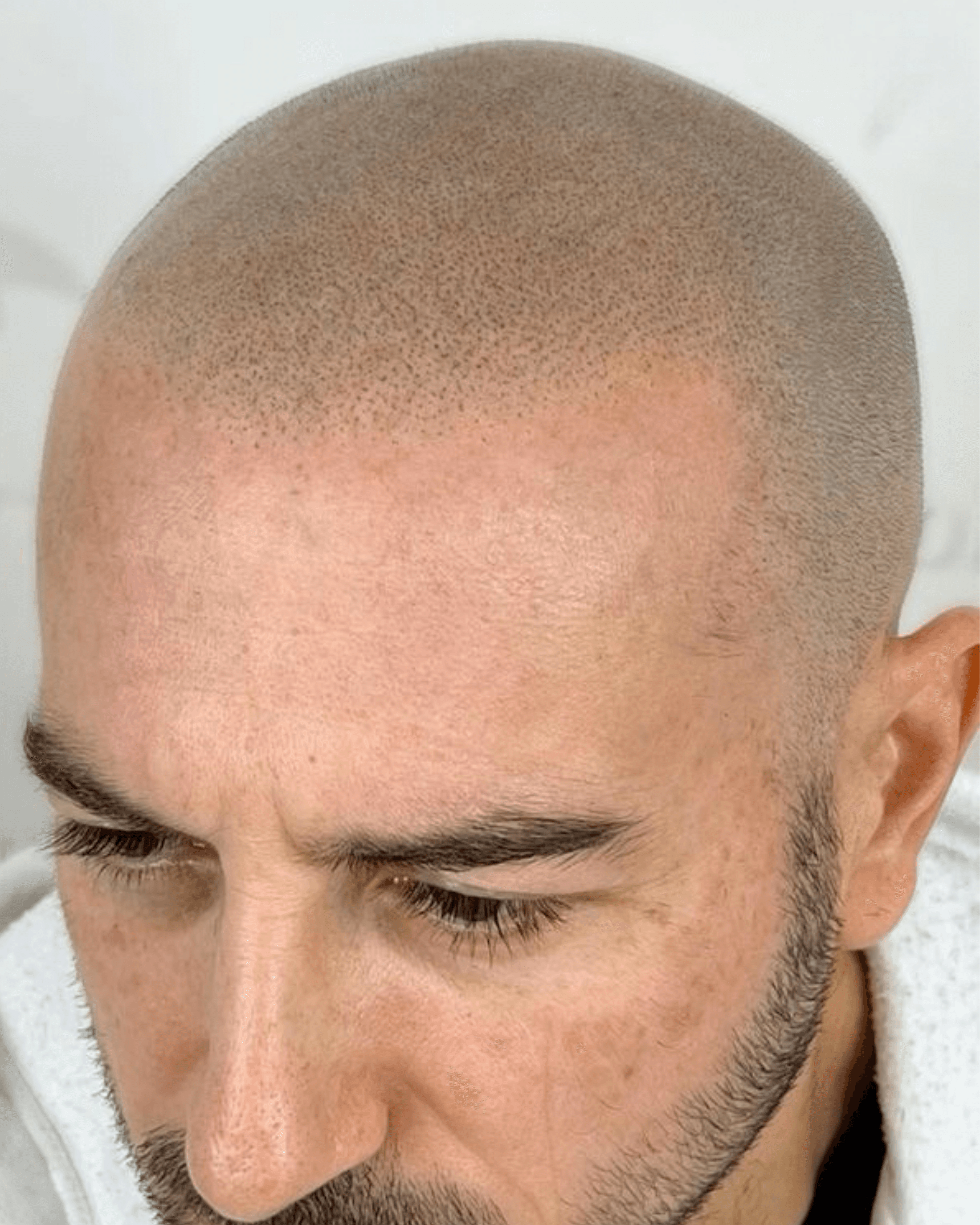 Scalp SMP. After treatment
