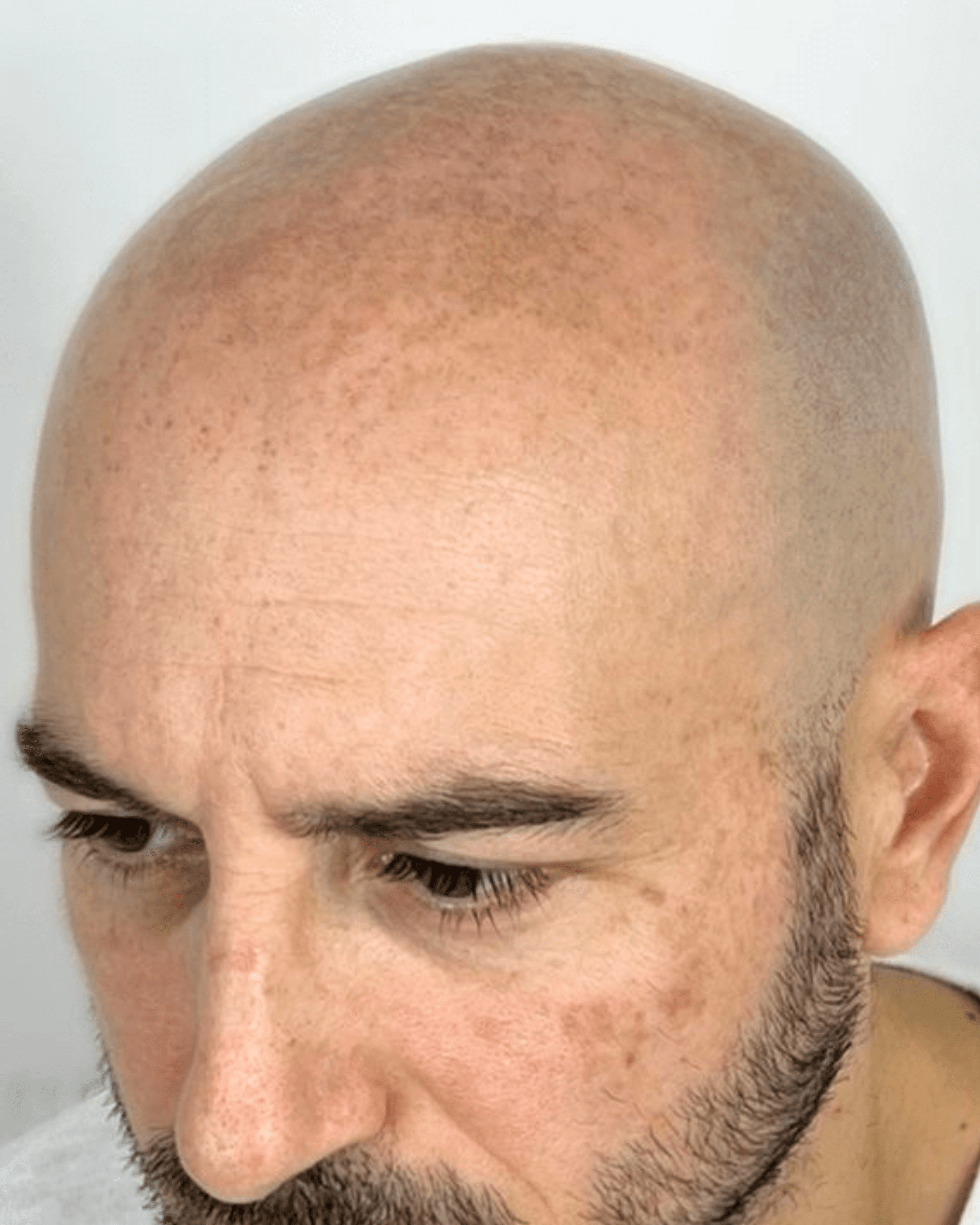 Scalp SMP. Before treatment